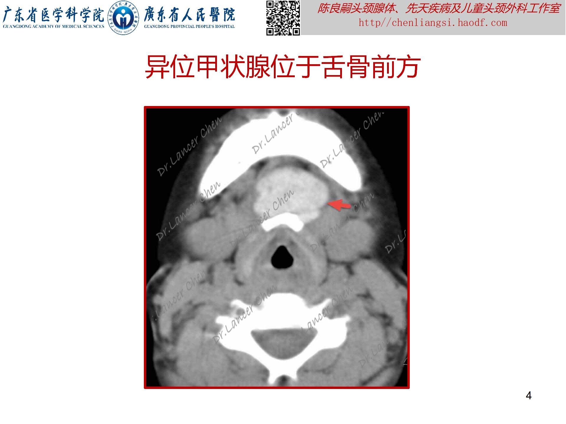 20230723：医学科普——貌似甲状舌管囊肿的罕见先天疾患——异位甲状腺_04.jpg