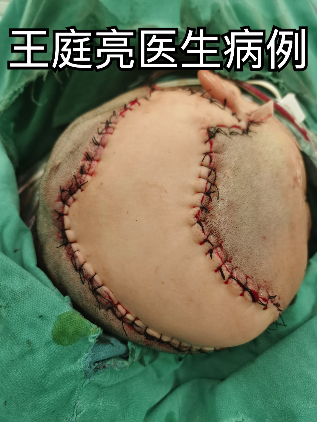 头皮钛网外露怎么办?游离皮瓣显身手