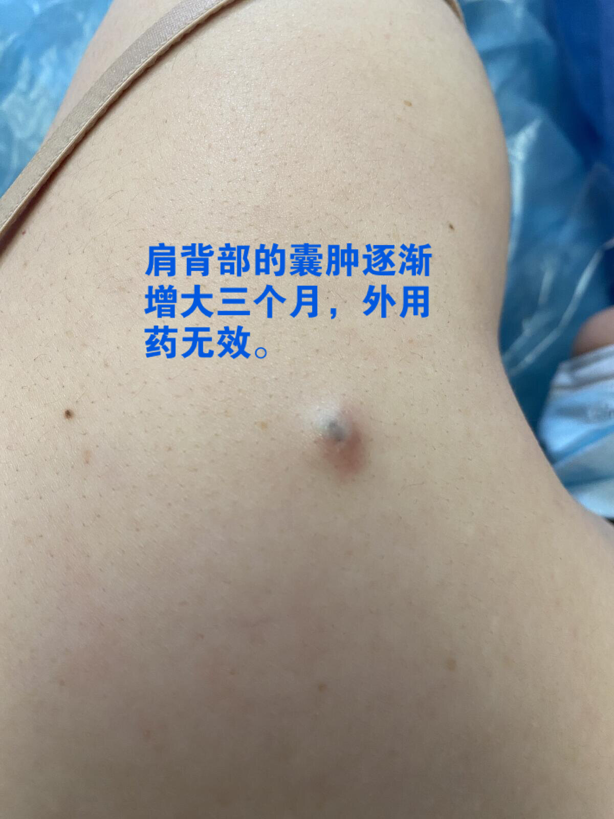 背上的小囊肿不消退怎么办?