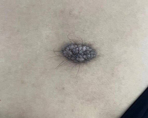 如何辨别“胎记”的好坏?_胎记_胎记介绍 - 好大夫在线