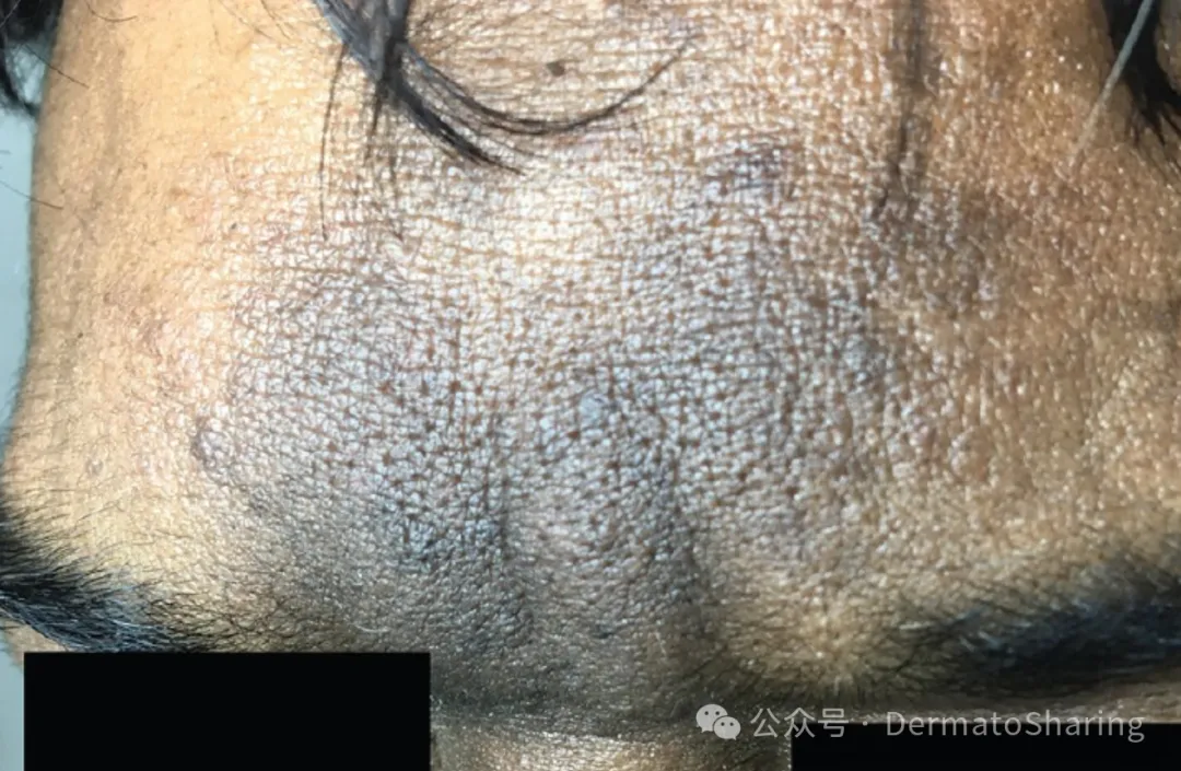 面部黑棘皮病:一种被严重低估的皮肤病!_皮肤黑变病_皮肤黑变病症状表现 - 好大夫在线