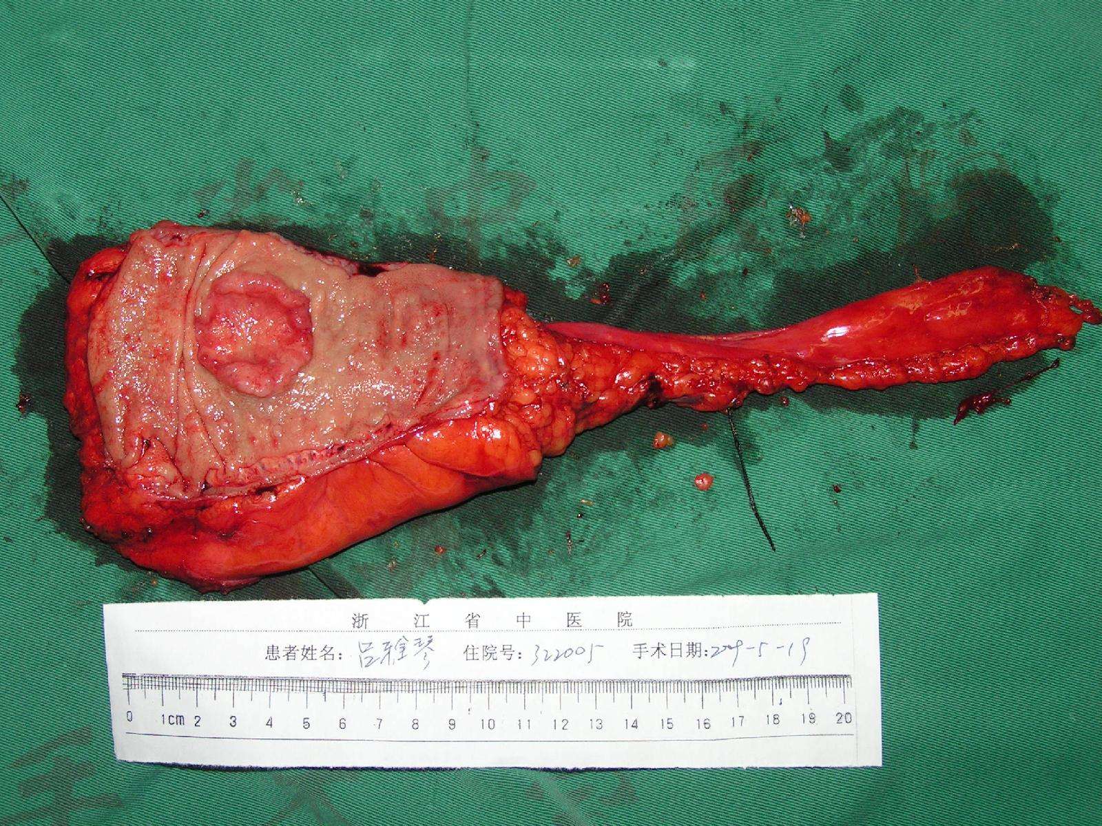 下切缘及环周切缘完整,直肠固有筋膜完整全切除.