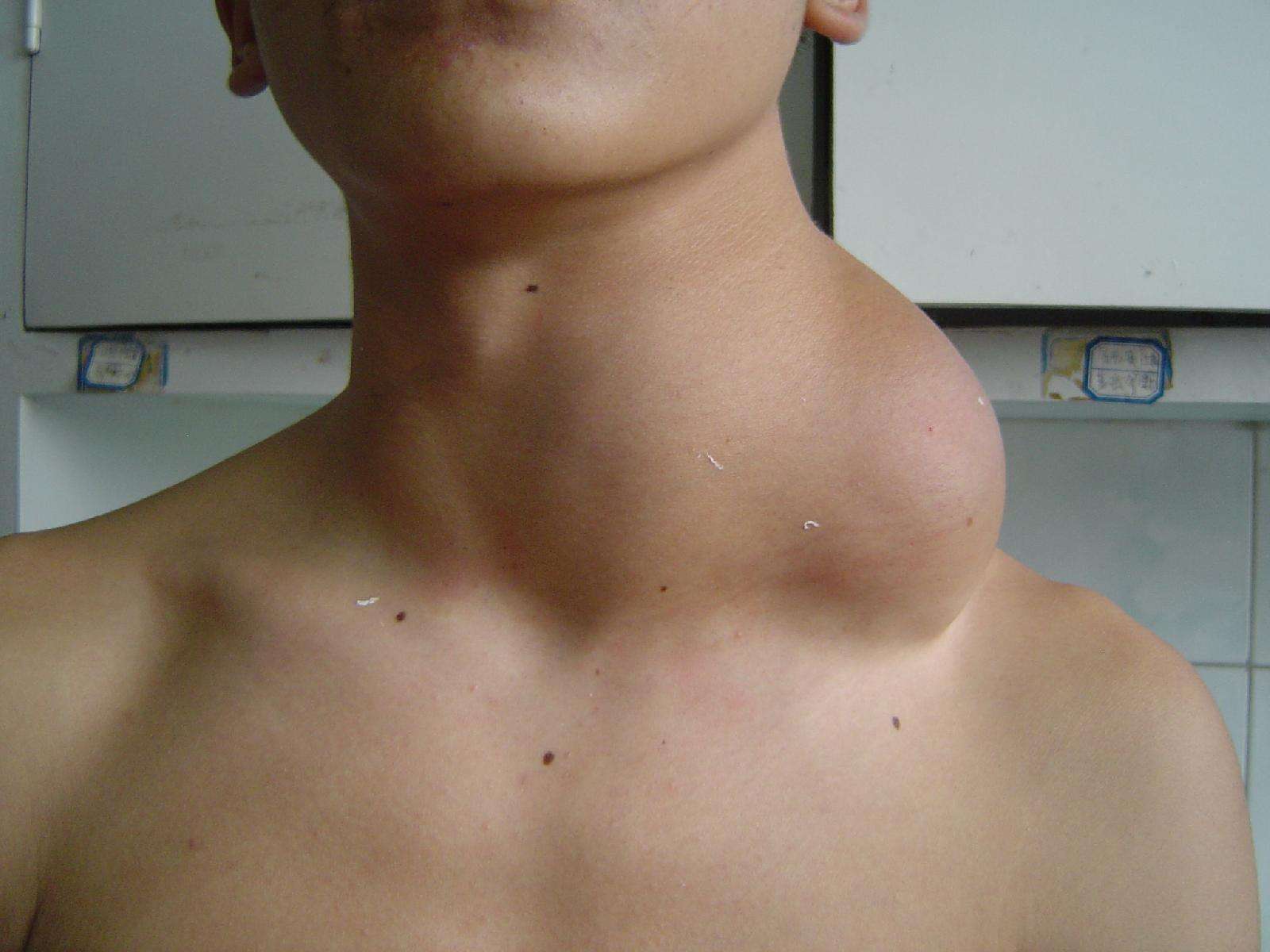 颈部淋巴结瘤的图片图片