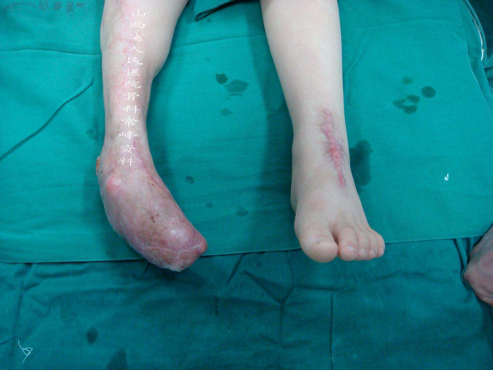 创伤后马蹄内翻足,足趾缺失,贴骨瘢痕 - 好大夫在线