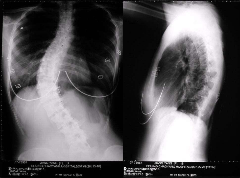 青少年特发性脊柱侧弯 典型病例2 
