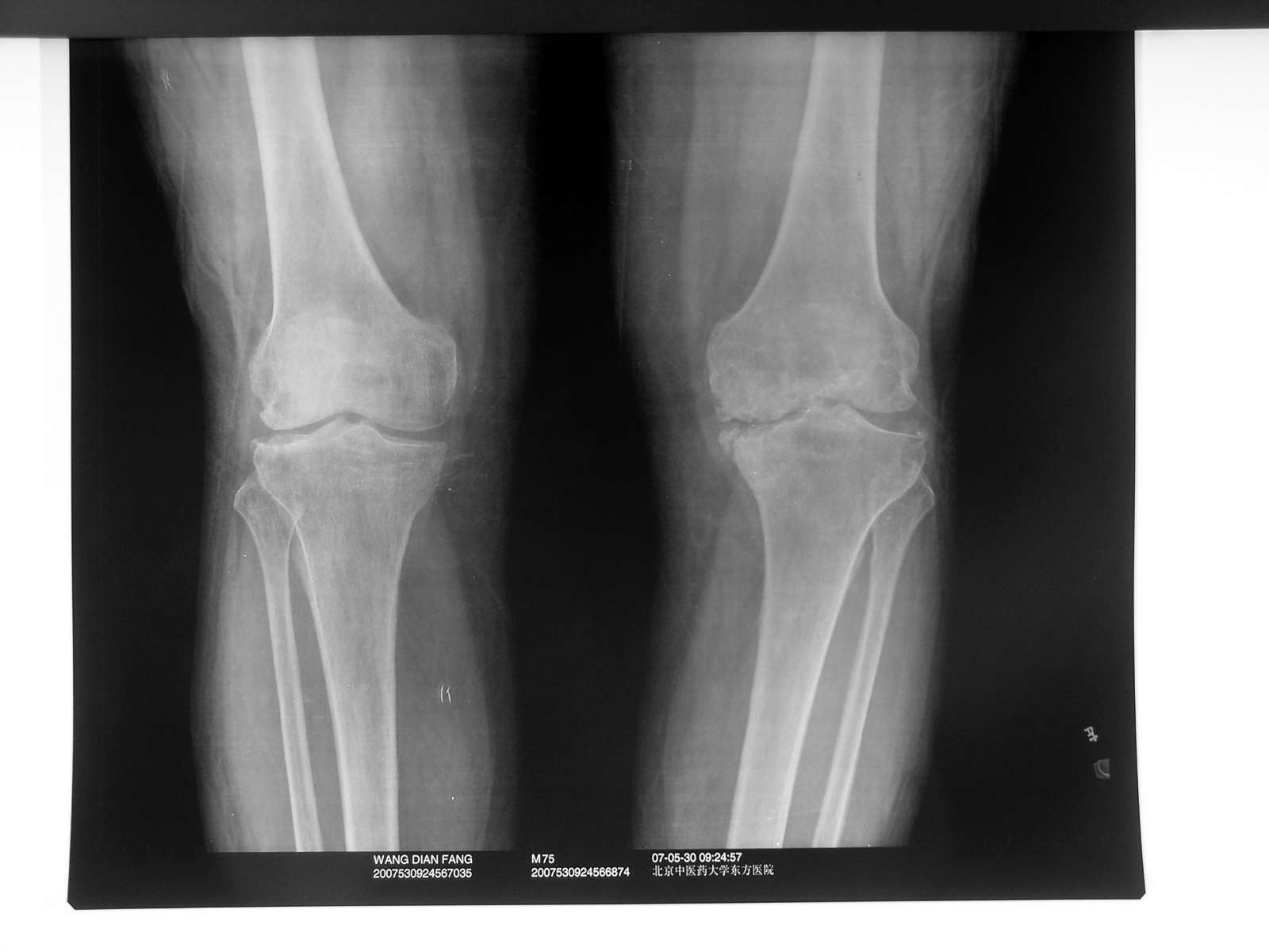 膝关节正常ct图片图片