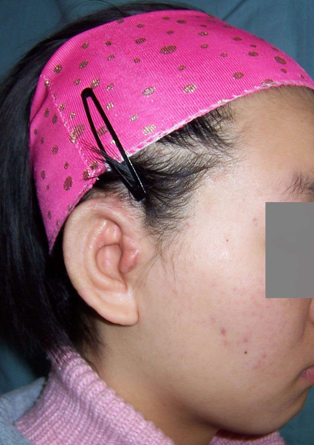 小耳畸形的耳郭再造术 - 好大夫在线