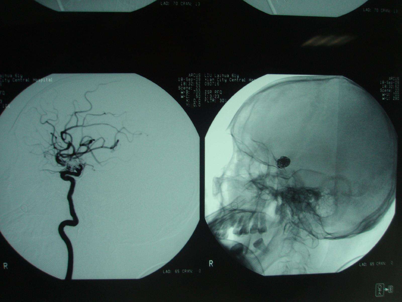 全脑血管造影术 - 好大夫在线