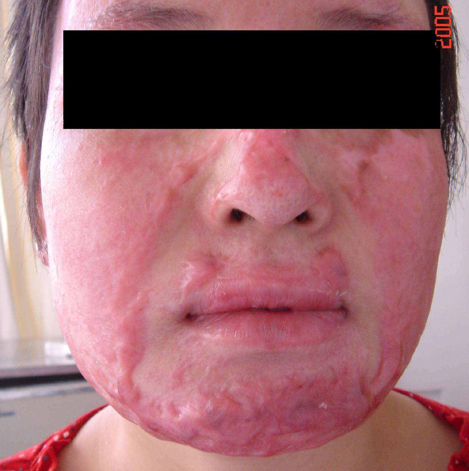 因疤痕表皮起水疱,破溃,病人不愿戴弹力面罩及用硅胶片,任其疤痕增生.