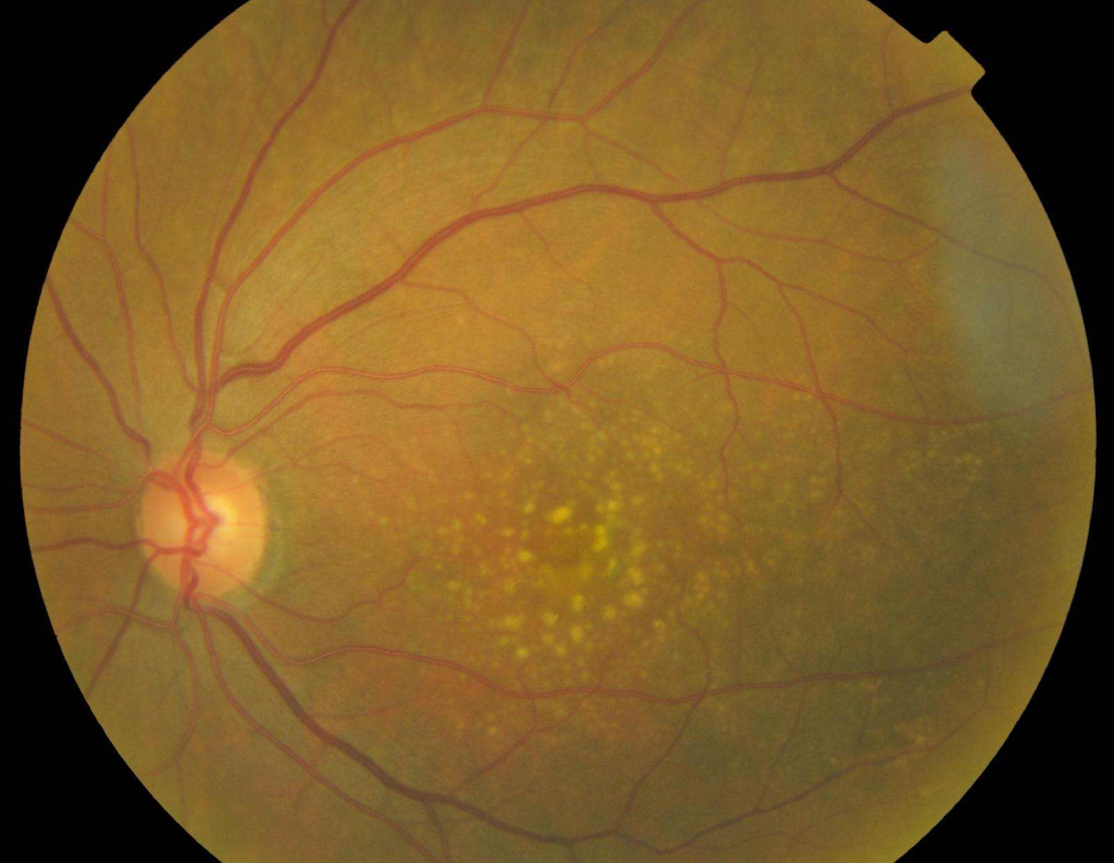 年龄相关性黄斑变性附图