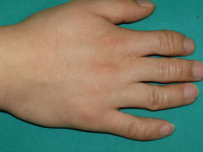 先天性手指短小症(短指症)的治疗方法