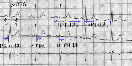 心电图常见干扰波形图片