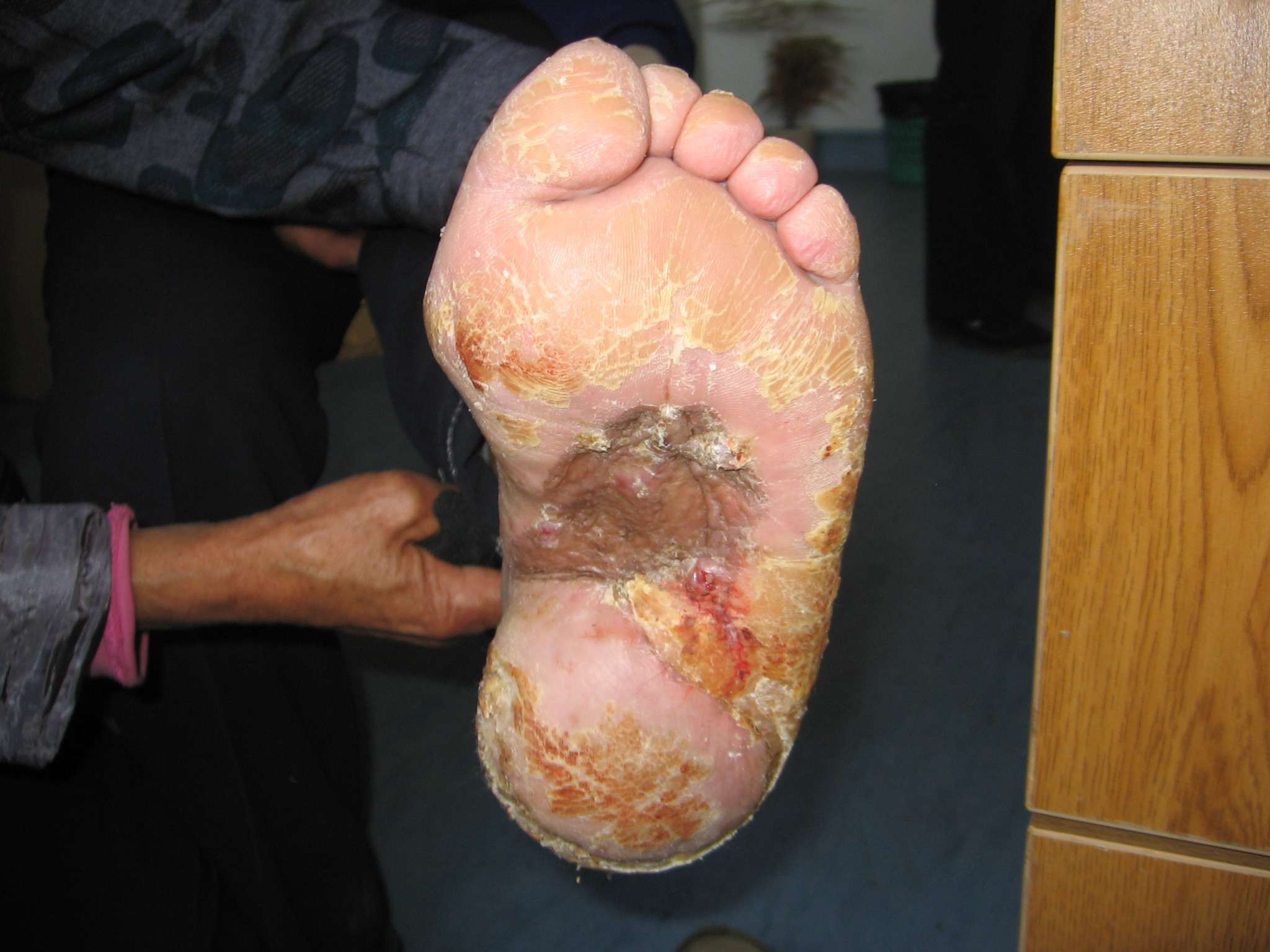 足跟底溃疡的修复治疗 - 好大夫在线