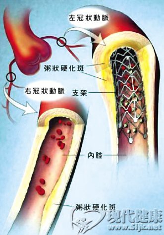冠状动脉粥样硬化及支架的示意图 - 好大夫在线