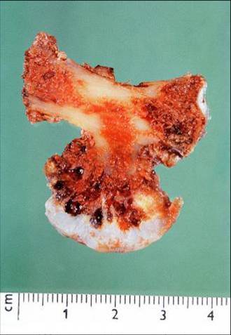 得了骨软骨瘤怎么办?_骨软骨瘤_手术_治疗方式 - 好大夫在线