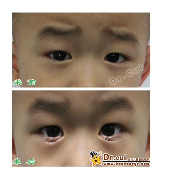 儿童倒睫手术图片