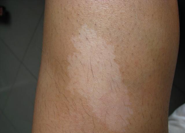 无色素痣 的表现及与白癜风和贫血痣的区别_痣_症状_症状表现 - 好