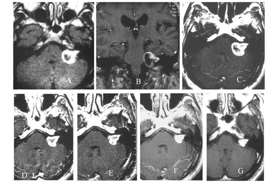 伽瑪刀治療中小型聽神經瘤的長期療效分析