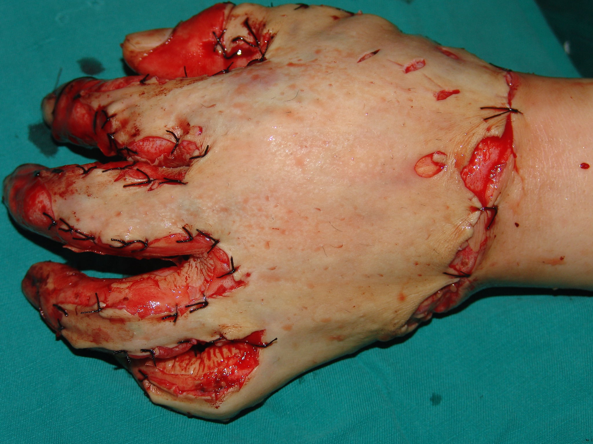 手部深度烧伤修复