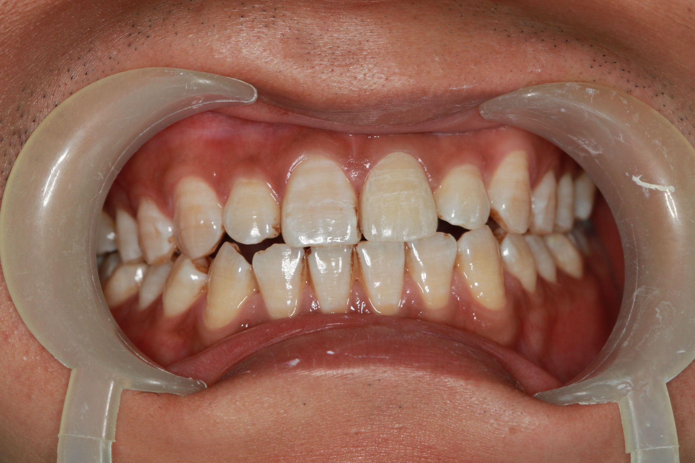 病例一:四环素牙的特殊染色 