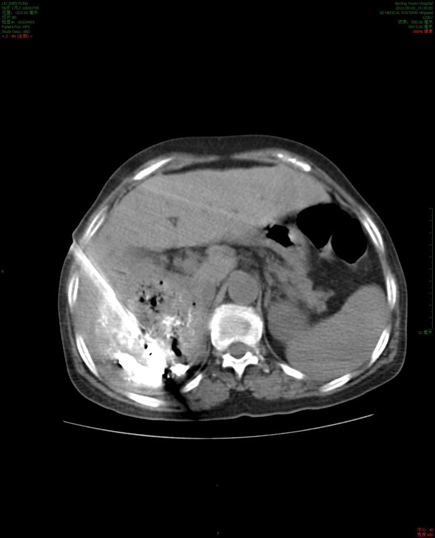 關于擅長:腫瘤介入治療:肝癌的超分割放射治療、經皮穿刺微波凝固治療、射頻治療;食管癌外照射與近...黃牛跑腿代掛-號販子有償代診業務已開通疫情解決看病難題的信息 關于擅長:腫瘤介入治療:肝癌的超分割放射治療、經皮穿刺微波凝固治療、射頻治療;食管癌外照射與近...黃牛跑腿代掛-號販子有償代診業務已開通疫情解決看病難題的信息