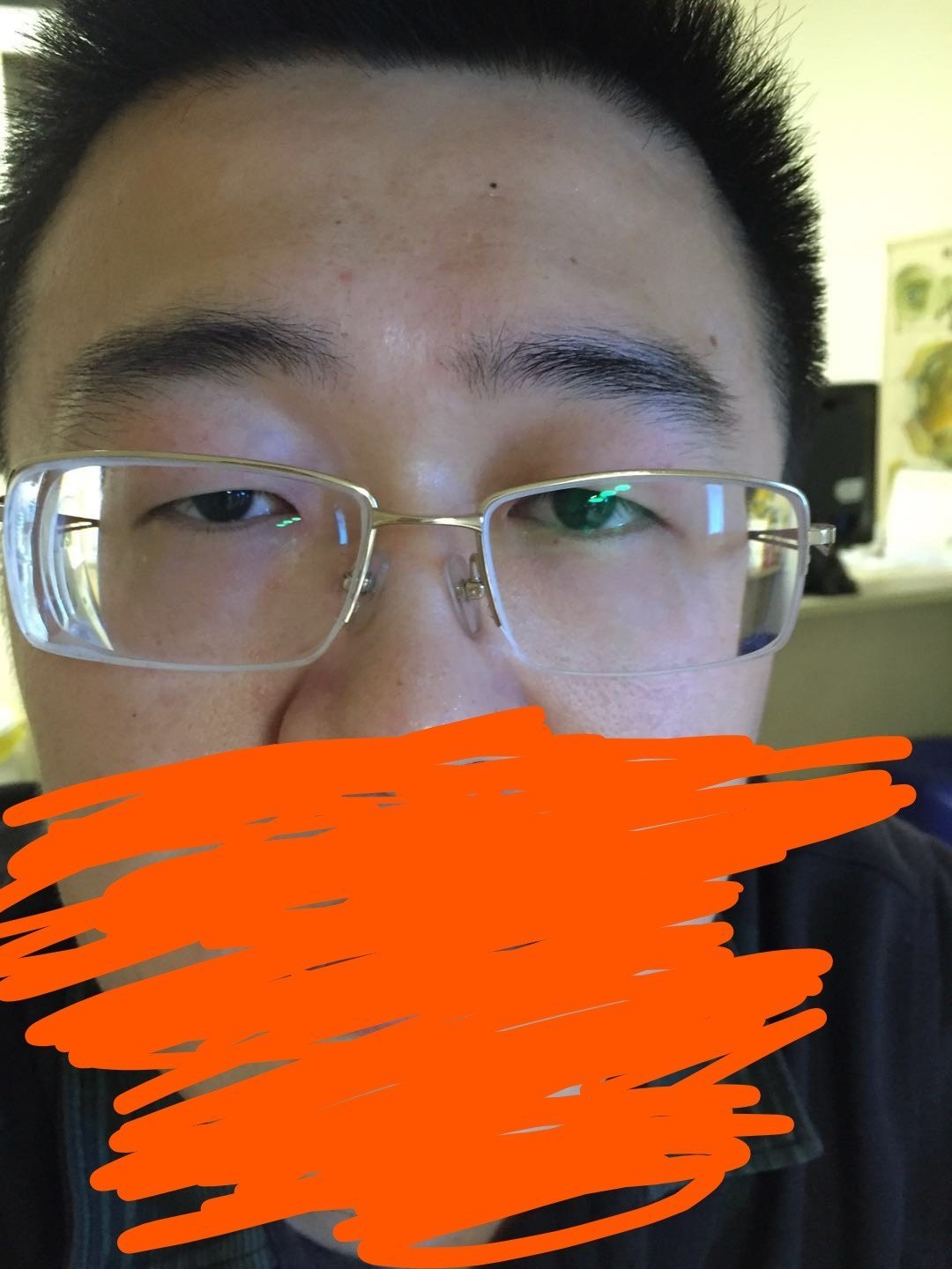 四年近视度数窜升600度,是因为上睑下垂吗?(图)