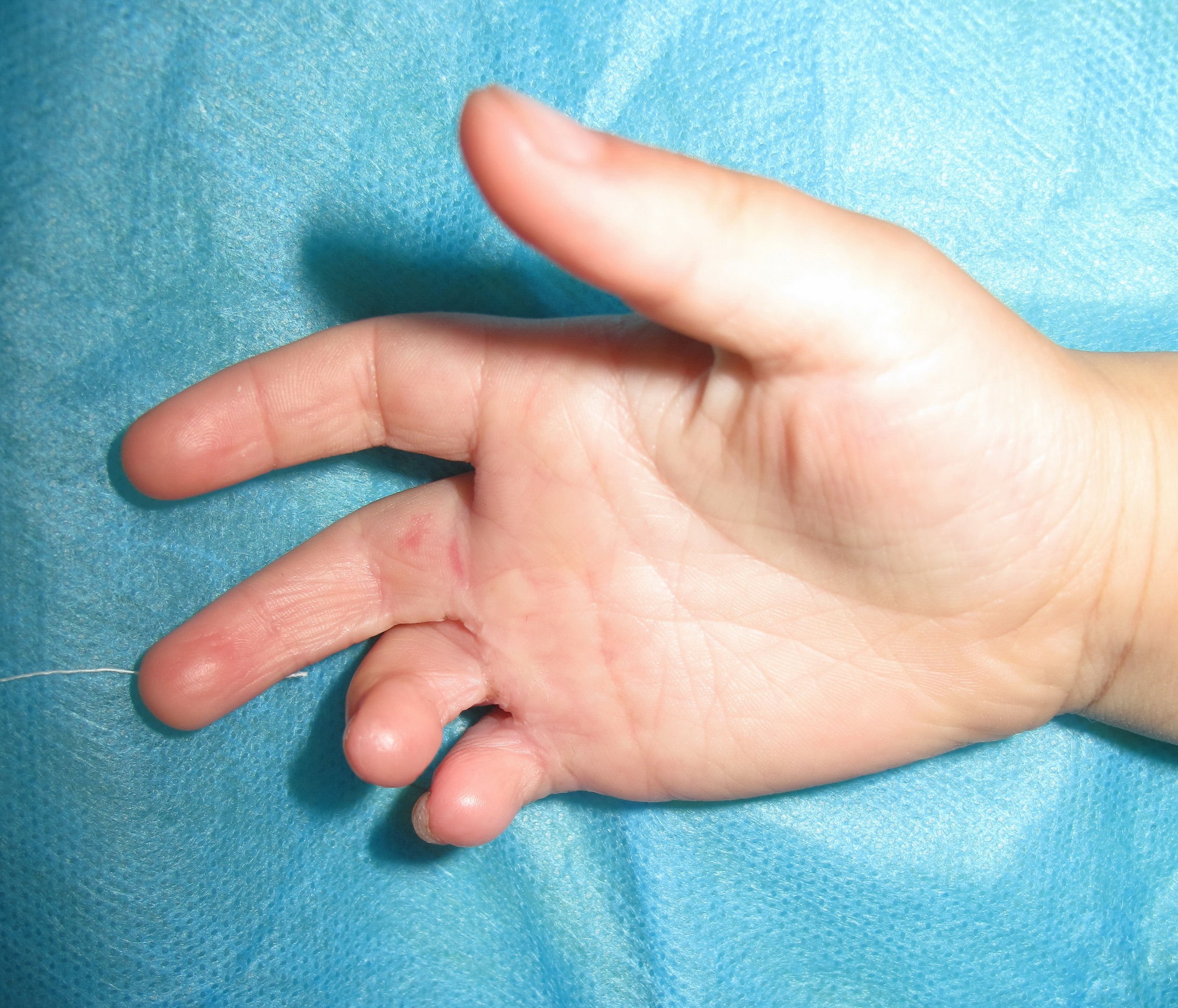 瘢痕松解,全厚皮片植皮,术后2周,皮片成活病例2,手指的植皮.
