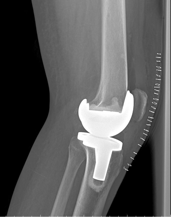人工膝关节的种类图片图片