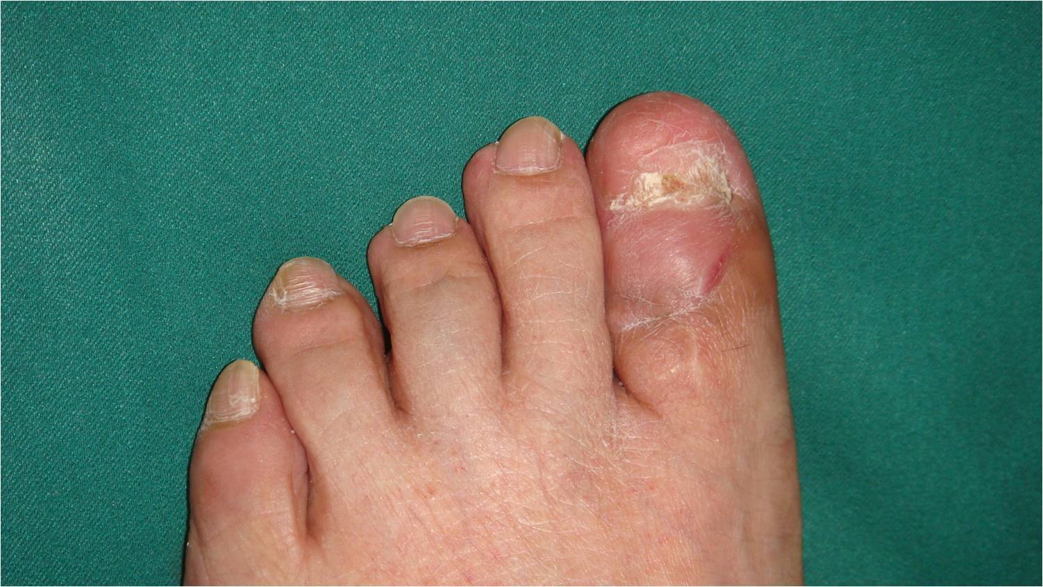 脚趾滑囊炎的症状图片图片
