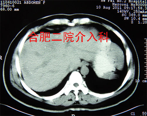 術前患者右腹部明顯高於左腹部術前ct平掃 增強顯示肝臟巨大血管瘤