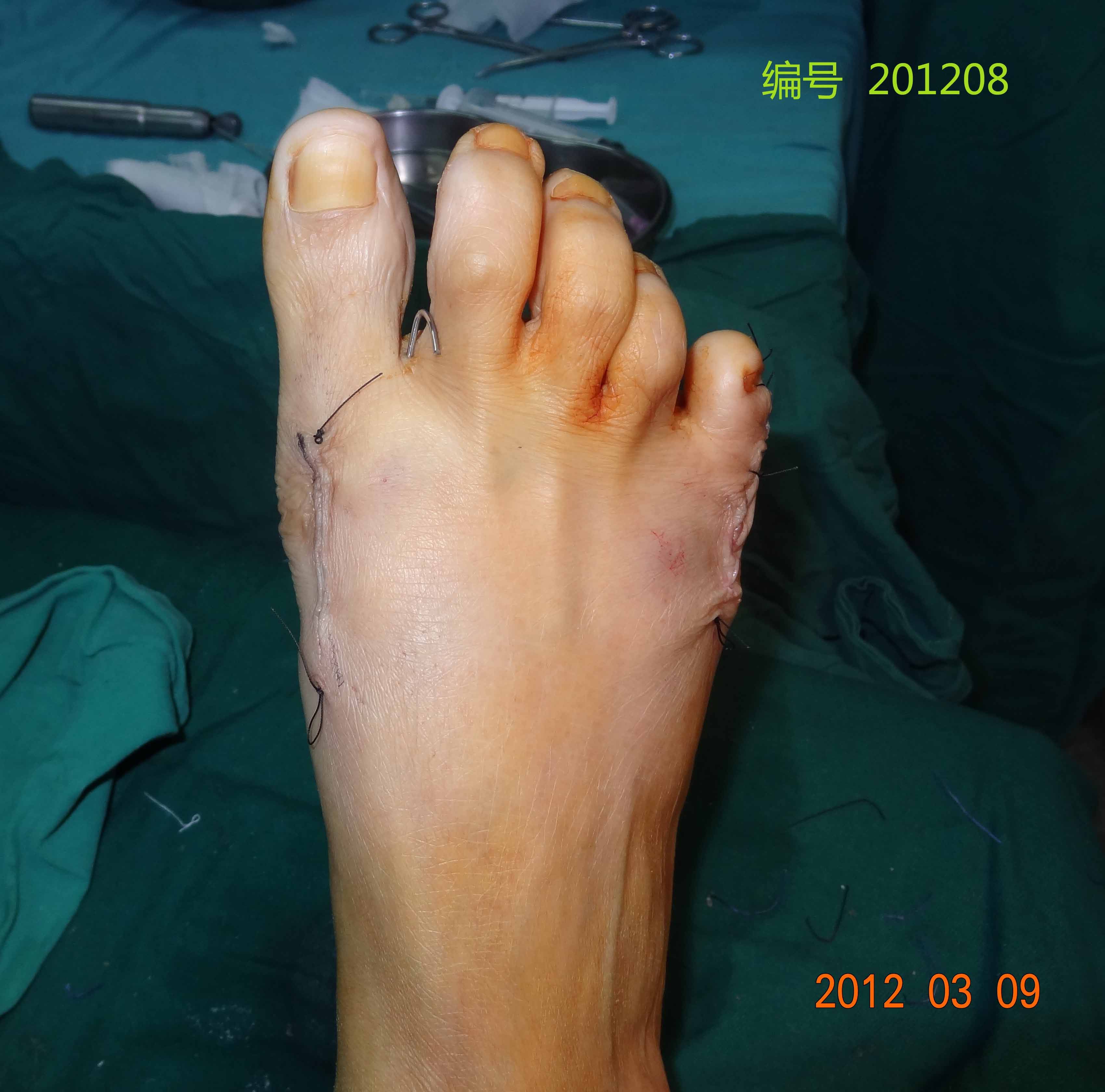 大脚骨手术过程图图片