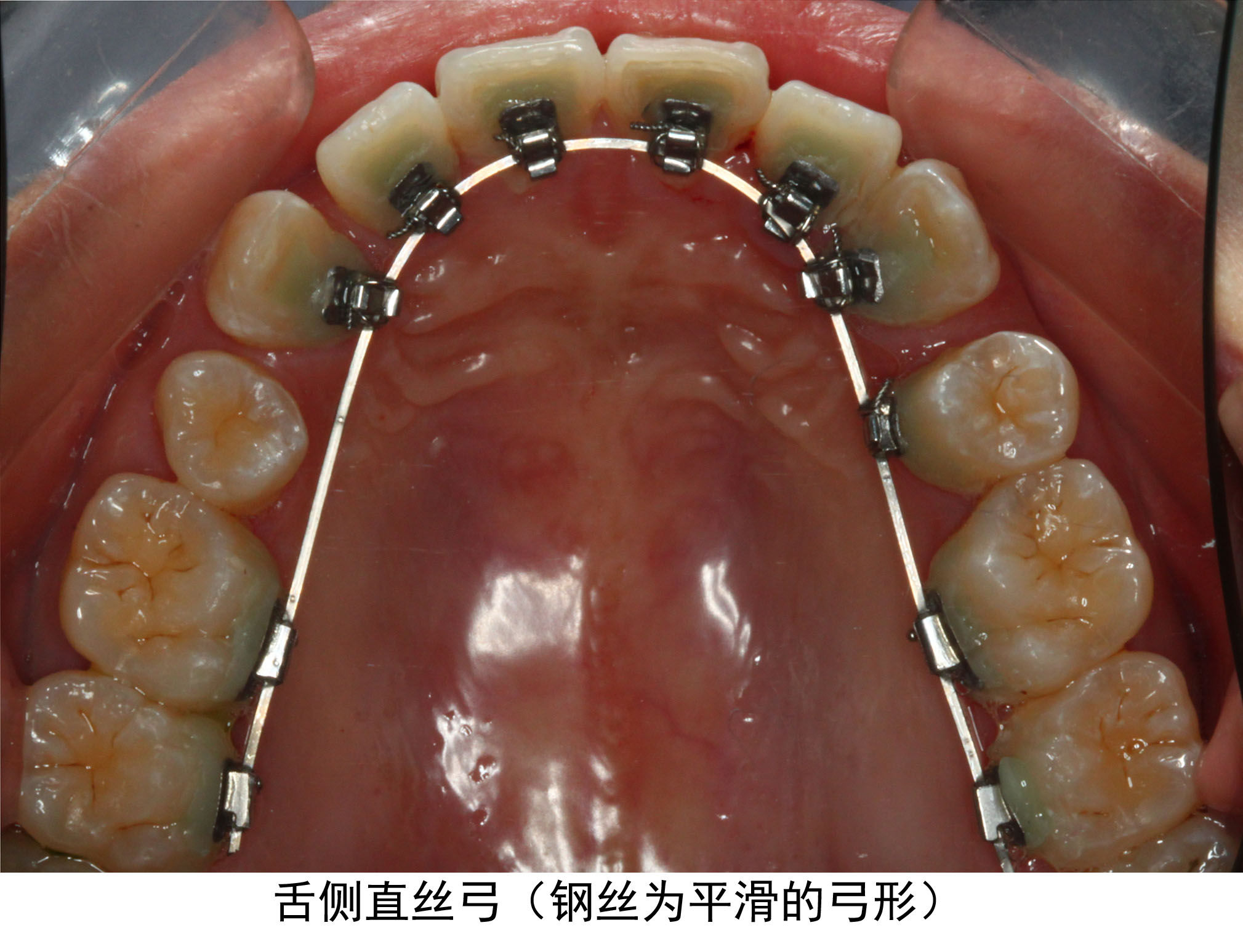 舌侧直丝弓矫正技术