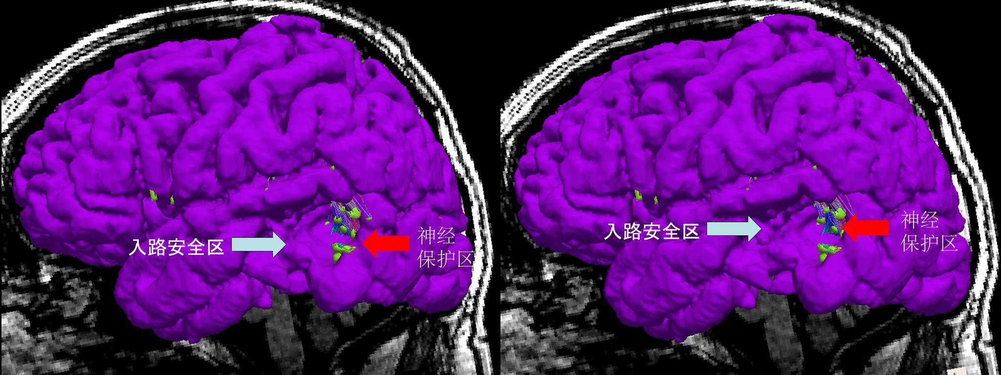 左顳葉語言功能相關區腫瘤膠質瘤手術策略傳導束成像的提示