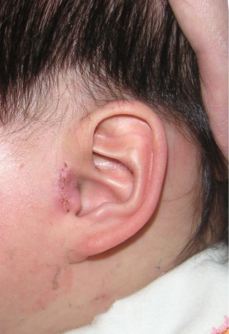 小儿整形---耳畸形篇(附耳,小耳畸形,杯状耳,招风耳,隐耳等) - 好大夫