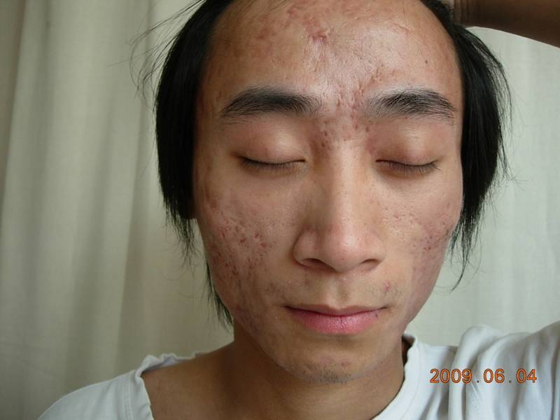 艾拉光动力治疗痤疮病历分享 - 好大夫在线