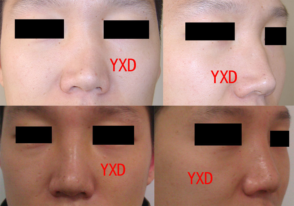 关于鼻骨骨折 歪鼻 处理 好大夫在线 关于鼻骨骨折 歪鼻 处理 好大夫在线