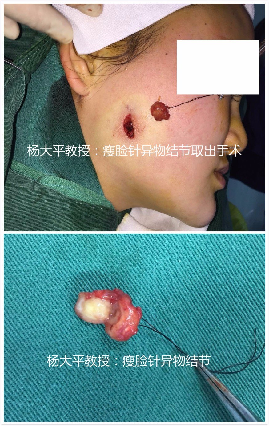 耳仓手术过程图片