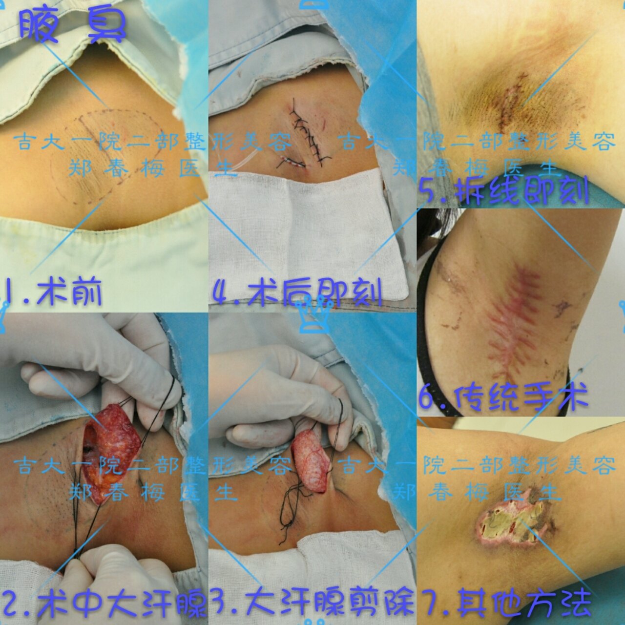 腋臭 狐臭 好大夫在线 腋臭 狐臭 好大夫在线