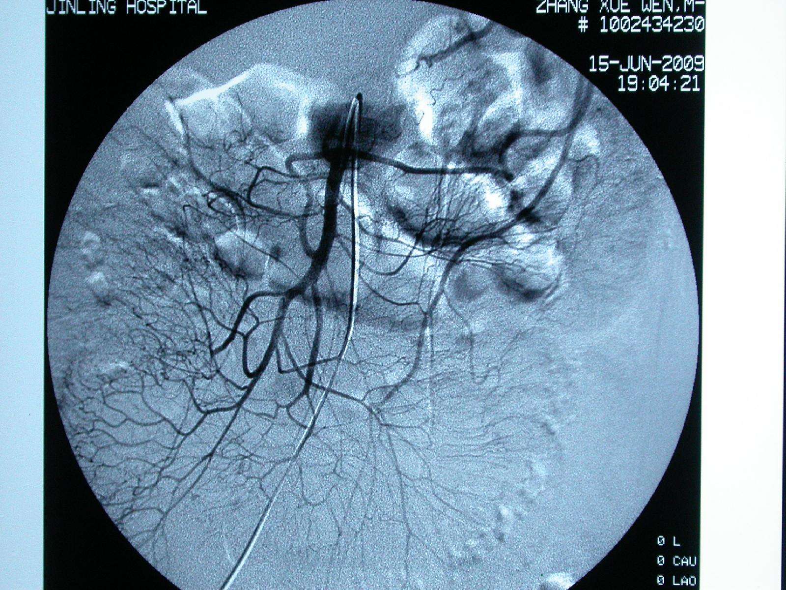 早期确定性手术治疗肠系膜上静脉血栓形成 - 好大夫在线