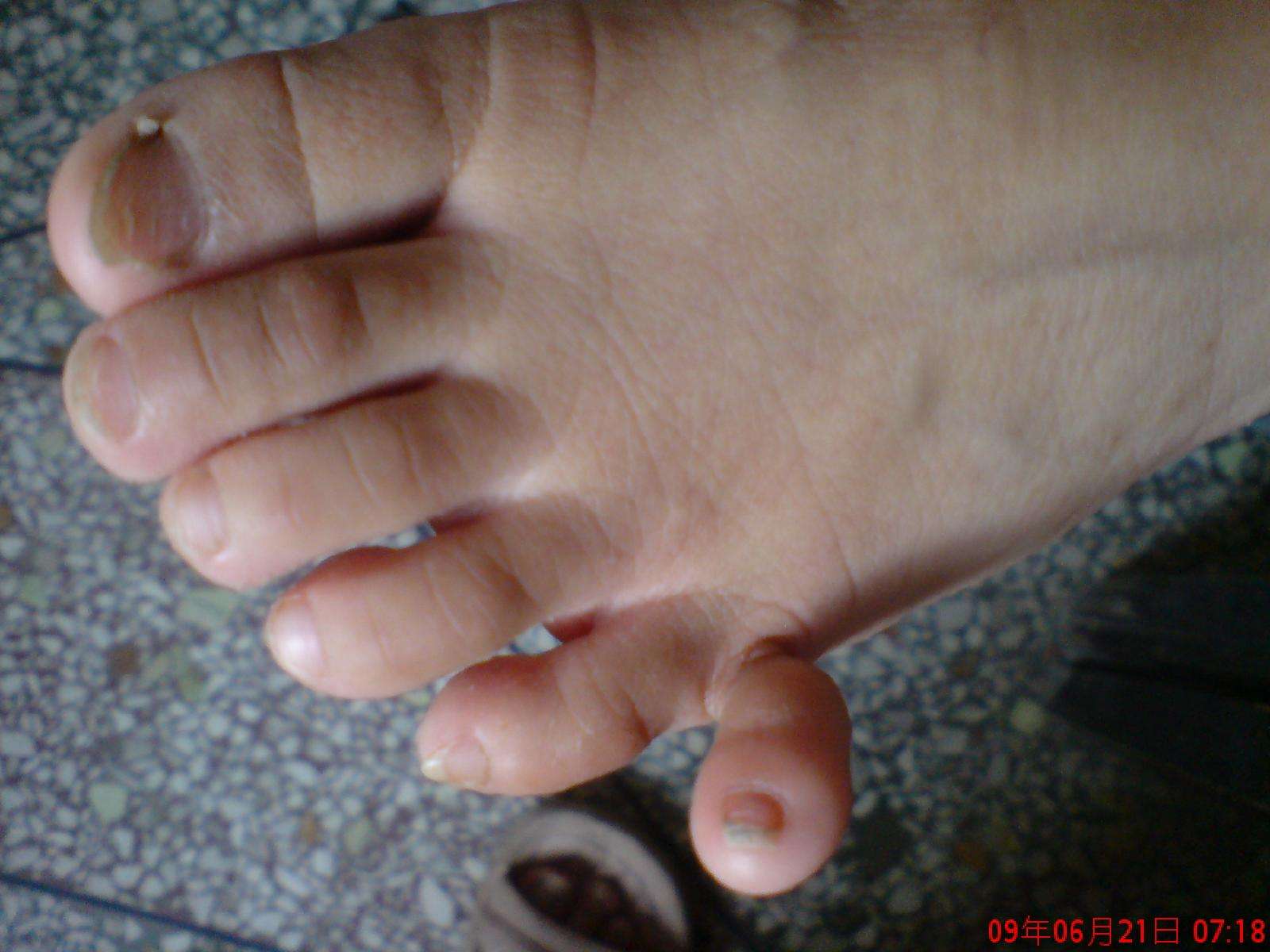 多趾畸形的病人 是个8岁的男孩 - 好大夫在线