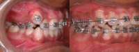 What is ORTHODONTICS? What is the best age for treatment?