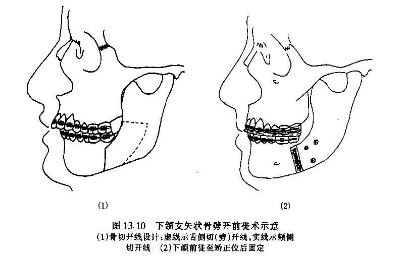 小下颌一定要手术吗图片