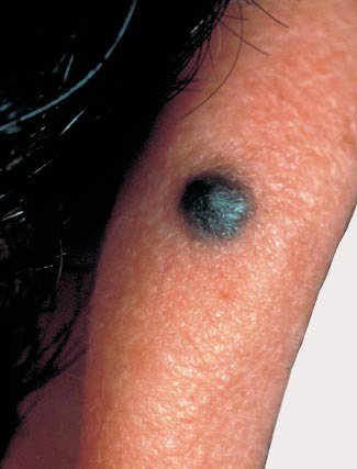 型黑色素瘤,为红色或黑色,表面光滑的凸起丘疹状,常见毛细血管扩张