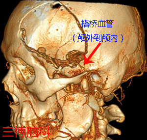 顳淺動脈大腦中動脈搭橋治療煙霧病