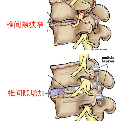 腰椎手术为什么要使用内固定螺钉