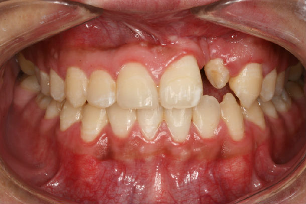 唇腭裂患者正畸治疗效果 - 好大夫在线