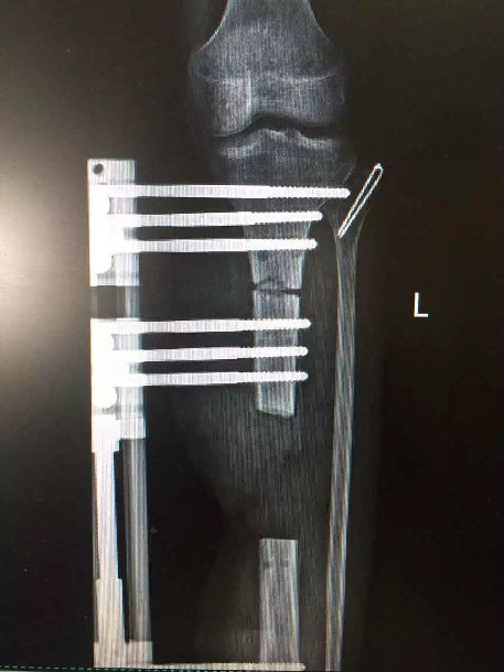 ilizarov骨延长治疗慢性骨髓炎(骨髓炎患者的福音) - 好大夫在线