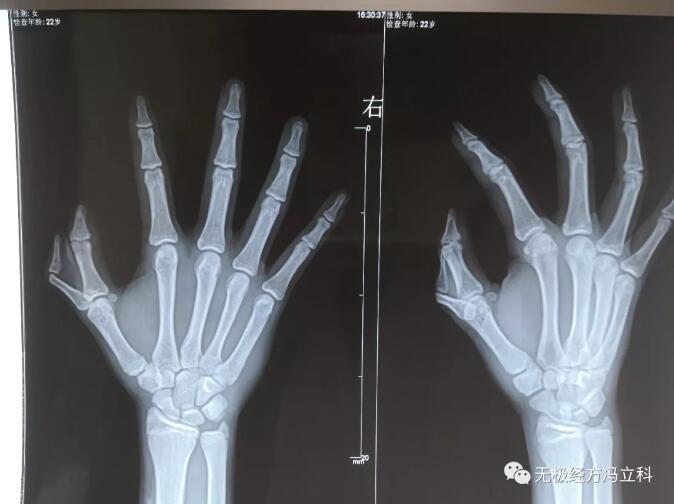 多指畸形矫形,还你一个正常的手指! - 好大夫在线