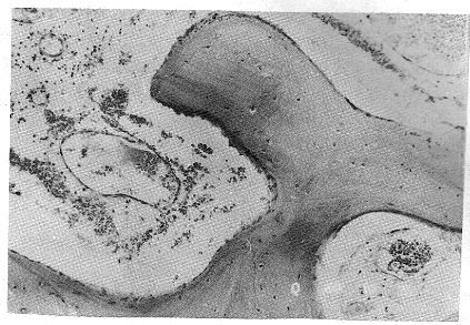骨血管瘤 骨血管瘤