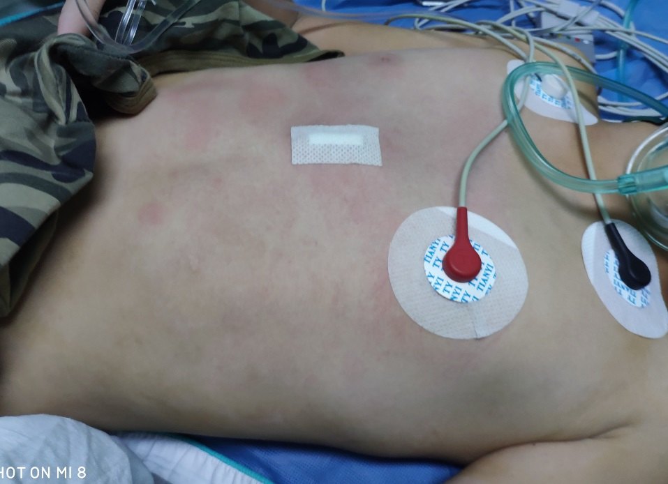 漏斗胸的Wang手术与沟状胸的Wang手术